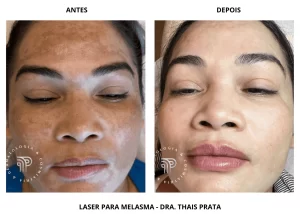 melasma