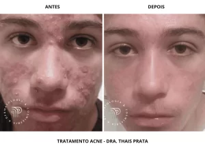 tratamentoacne