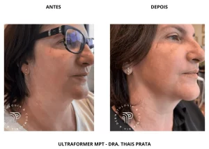 papada