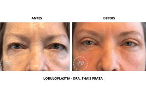 lobuloplastia