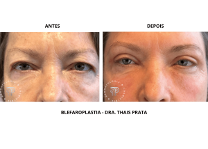 blefaroplastia_bc